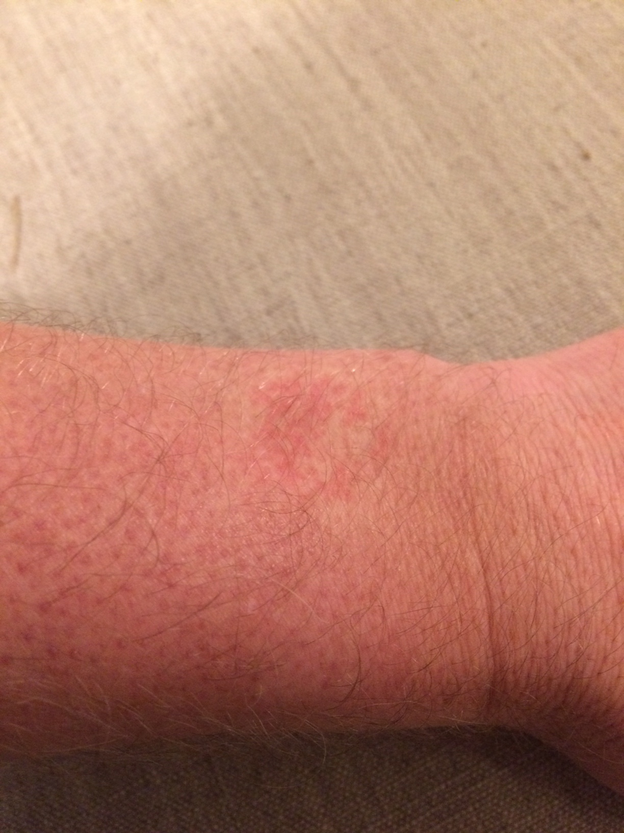 Rash Or Irritation Happening On My Wrist By The Vivoactive 3 Vivoactive 3 Series Health Wellness Garmin Forums