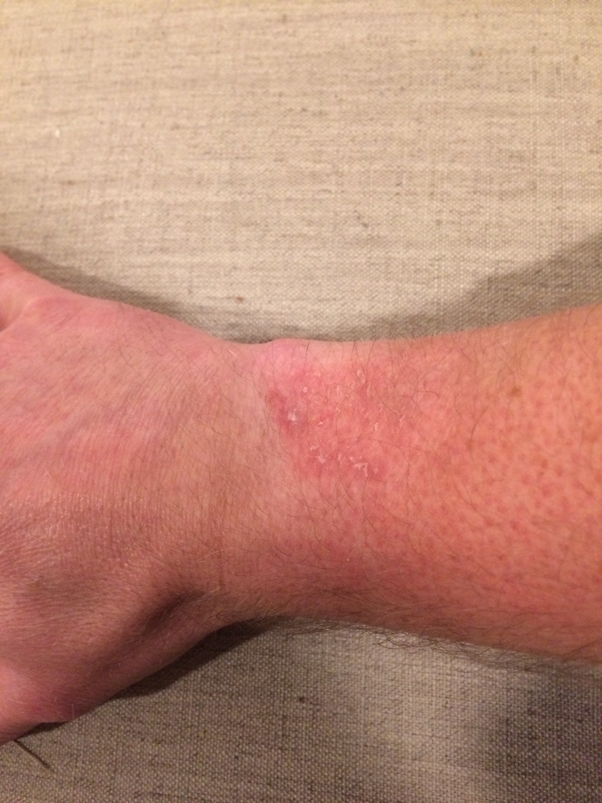Rash Or Irritation Happening On My Wrist By The Vivoactive 3 Vivoactive 3 Series Health Wellness Garmin Forums