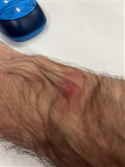 Garmin watch outlet rash