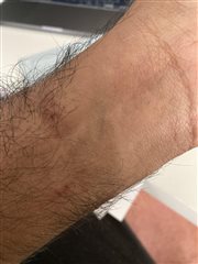 Forming patches on skin