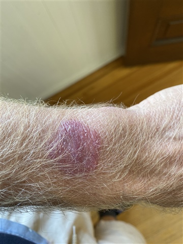 Garmin 945 skin rash burn Forerunner 945 Running Multisport Garmin Forums