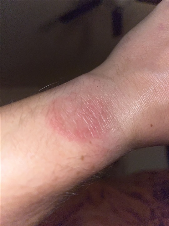 Anyone else is getting burn marks from the silicone band? : r/Garmin