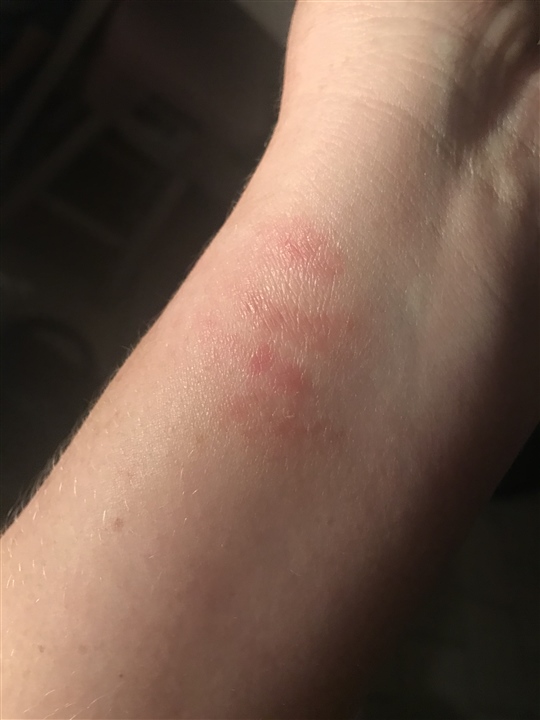 Watch strap causing rash fēnix 6 Series Wearables Garmin Forums