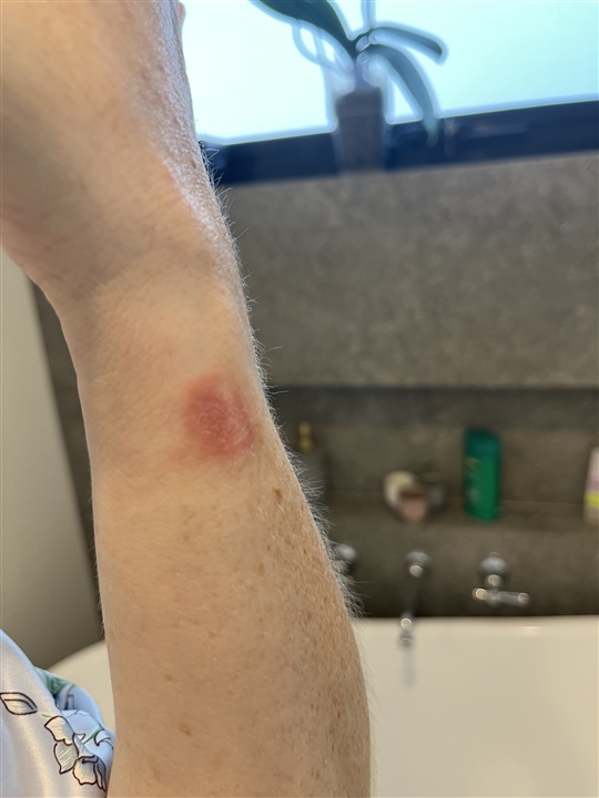 Burn from watch f nix 7 Series Wearables Garmin Forums
