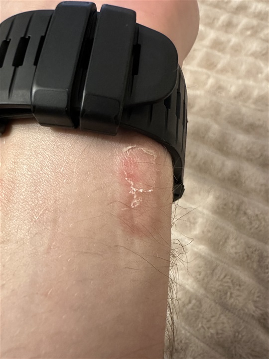 Skin irritation from EPIX Pro stock band Epix Gen 2 Series Wearables Garmin Forums